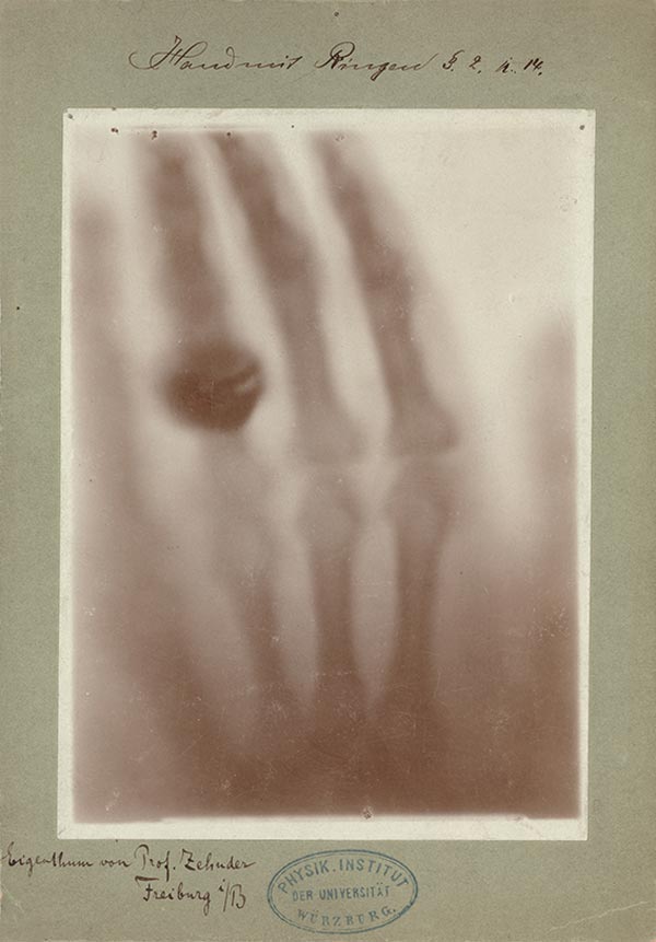 Röntgenaufnahme der Hand von Anna Bertha Röntgen.